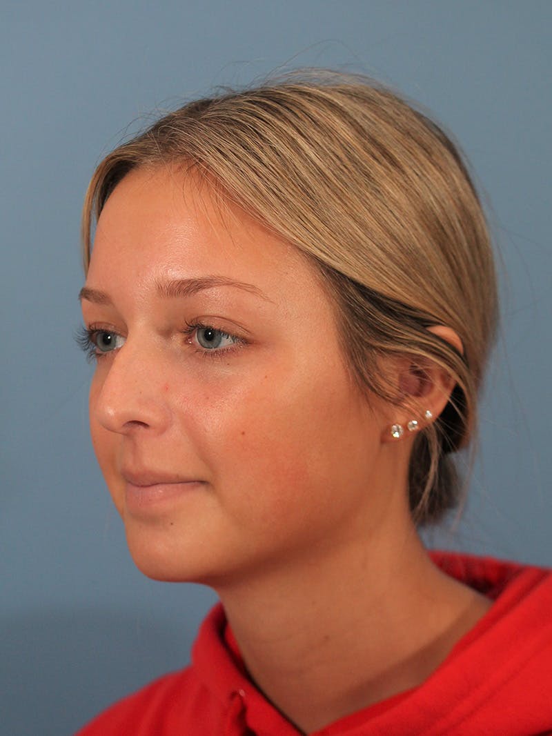 Rhinoplasty Before & After Gallery - Patient 404843 - Image 3