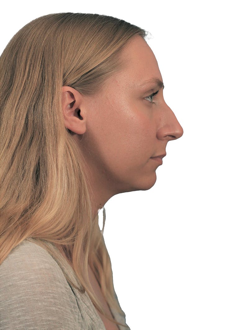 Rhinoplasty Before & After Gallery - Patient 266488 - Image 1