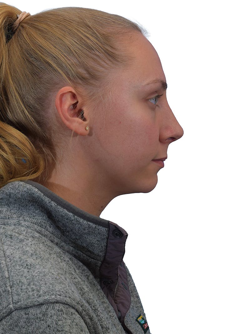 Rhinoplasty Before & After Gallery - Patient 266488 - Image 2