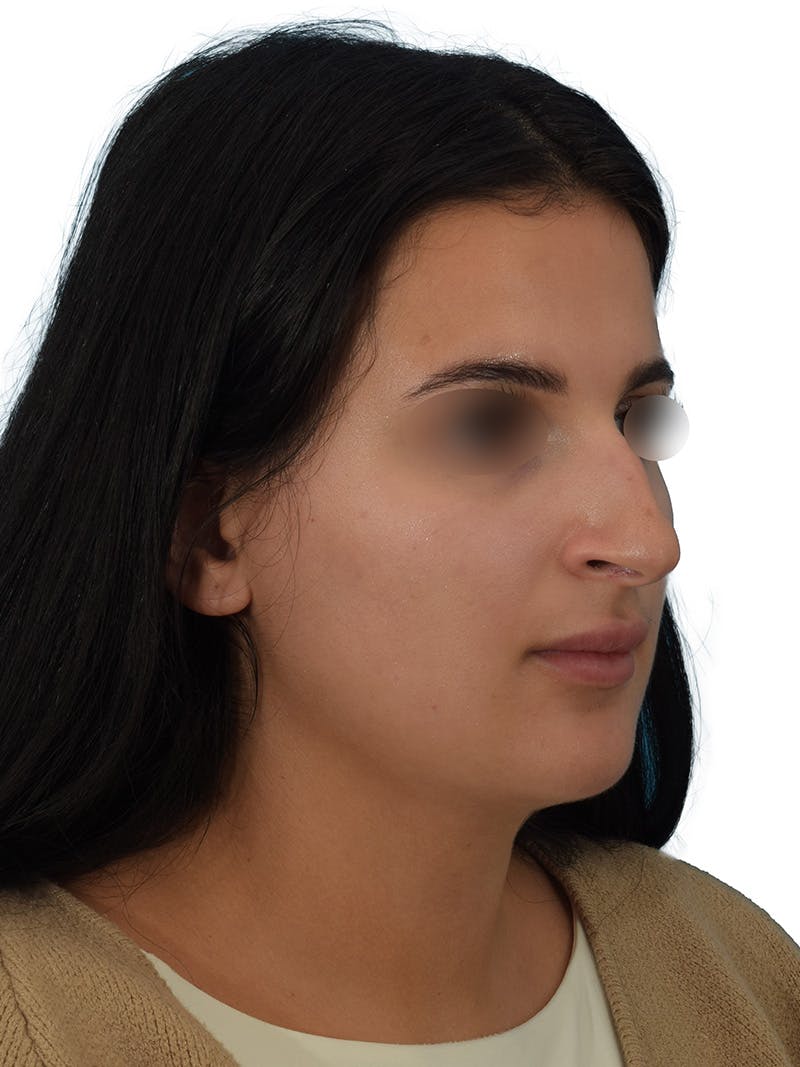 Rhinoplasty Before & After Gallery - Patient 229604 - Image 3