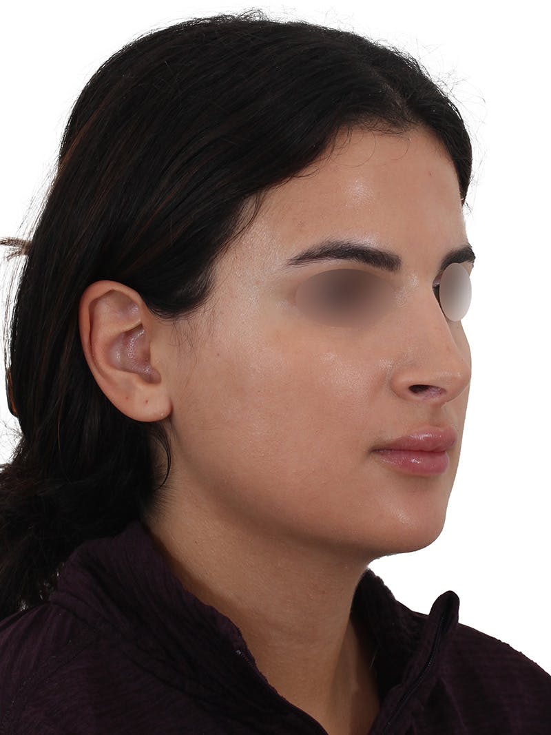 Rhinoplasty Before & After Gallery - Patient 229604 - Image 4