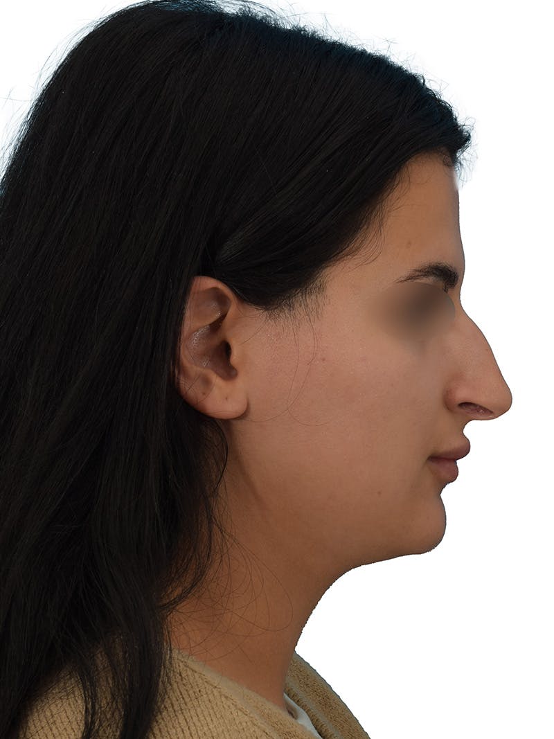 Rhinoplasty Before & After Gallery - Patient 229604 - Image 1