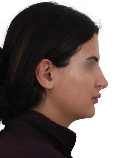 Rhinoplasty Before & After Gallery - Patient 229604 - Image 2