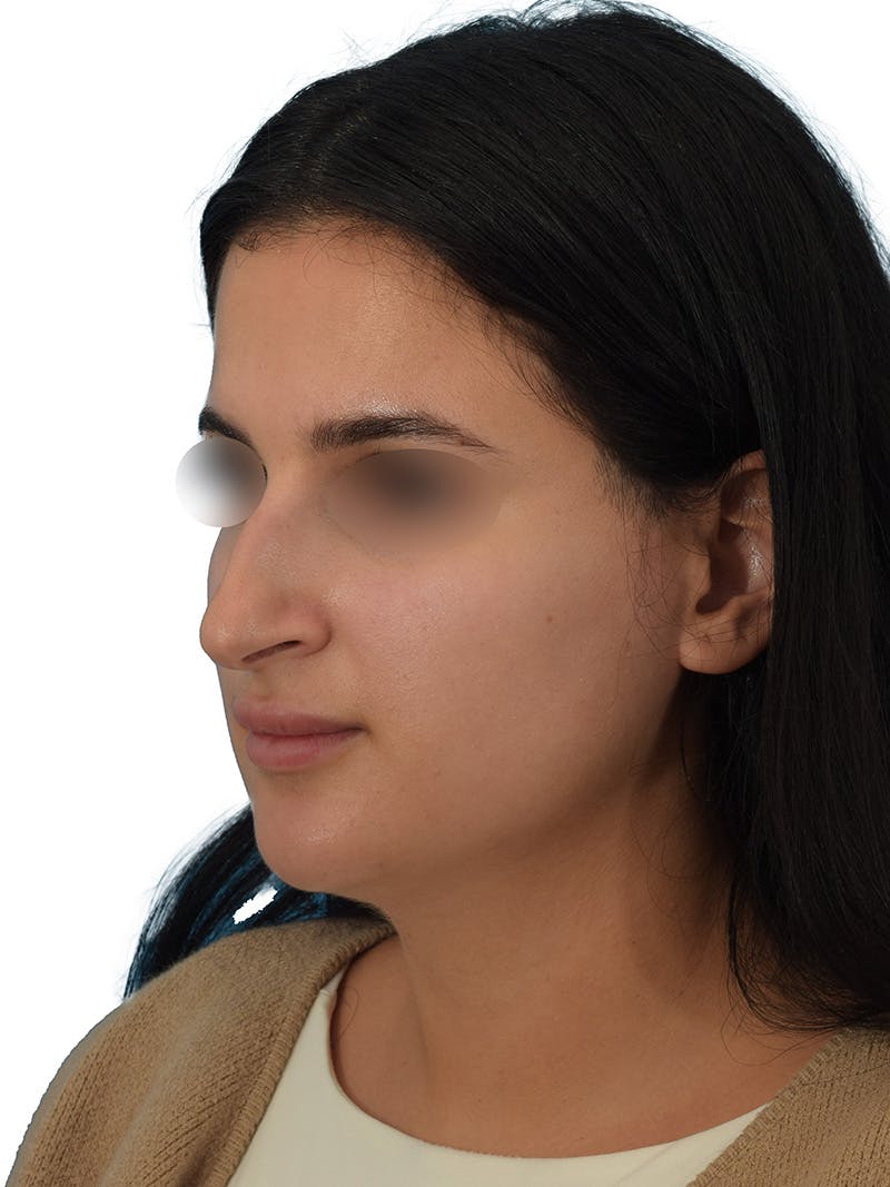 Rhinoplasty Before & After Gallery - Patient 229604 - Image 7
