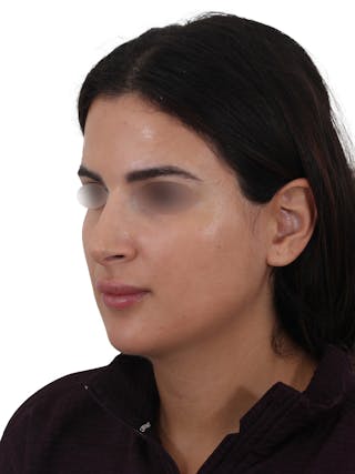 Rhinoplasty Before & After Gallery - Patient 229604 - Image 8