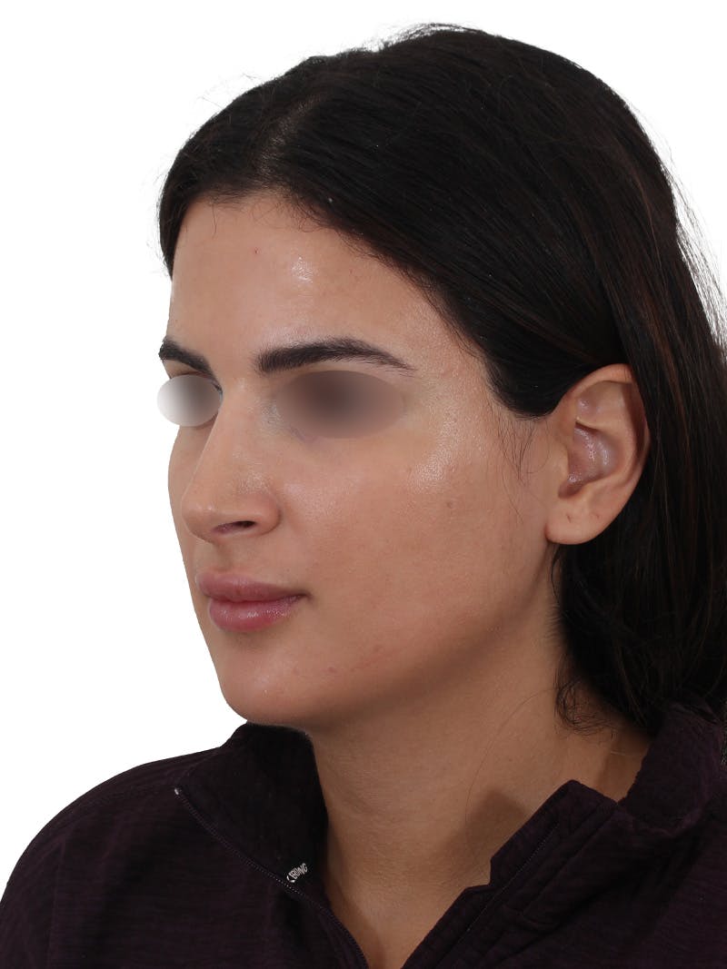 Rhinoplasty Before & After Gallery - Patient 229604 - Image 8