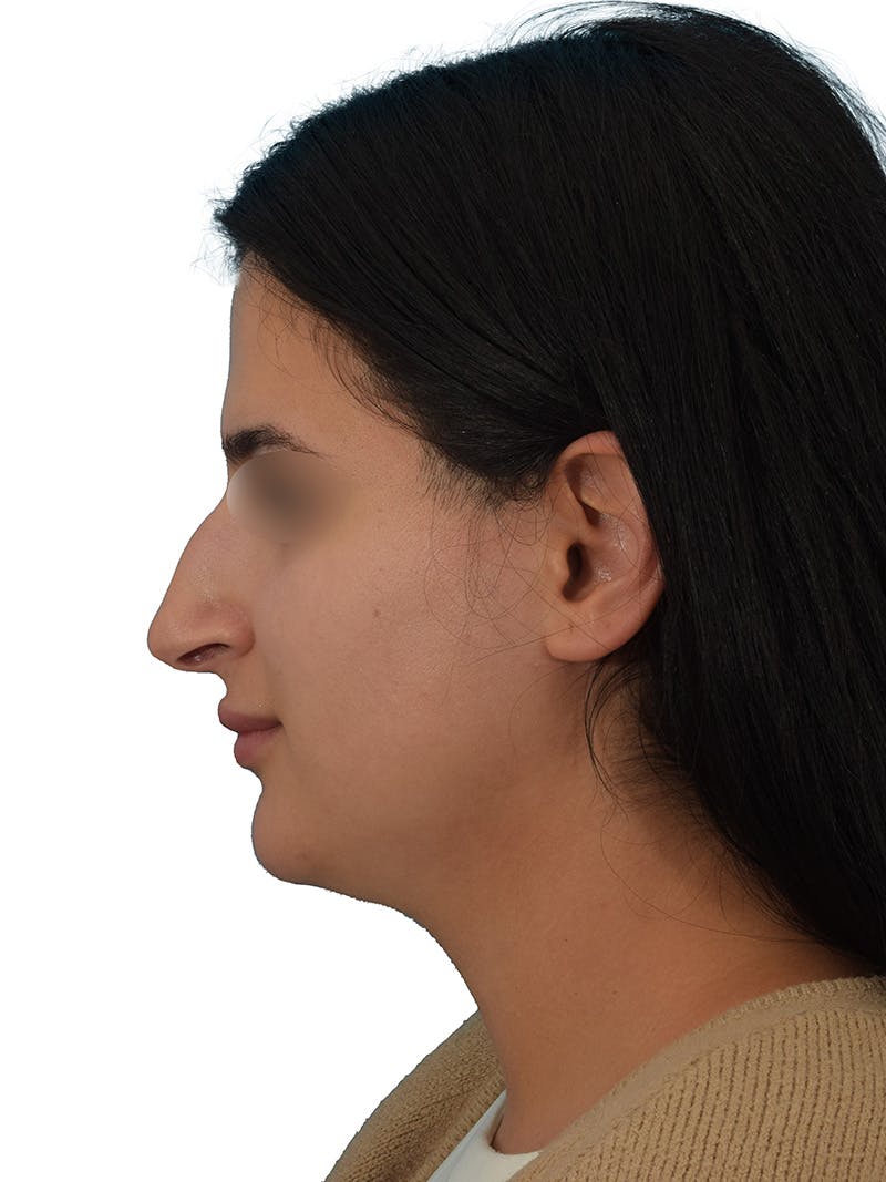 Rhinoplasty Before & After Gallery - Patient 229604 - Image 9