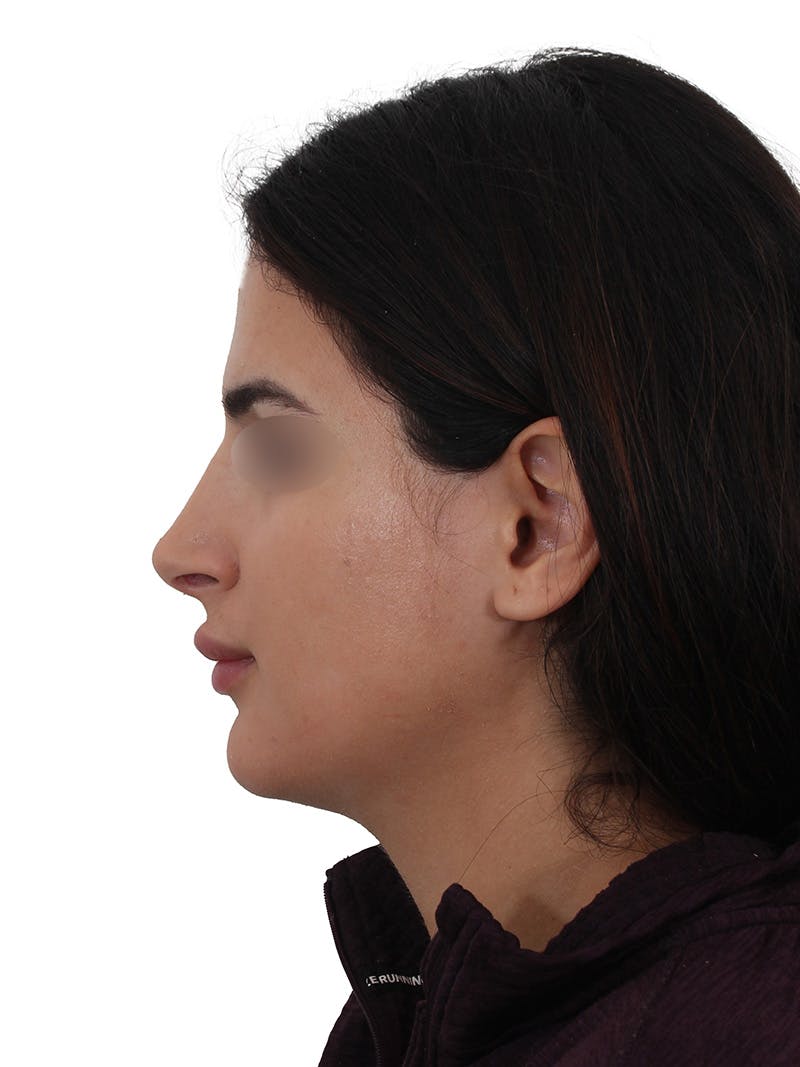 Rhinoplasty Before & After Gallery - Patient 229604 - Image 10