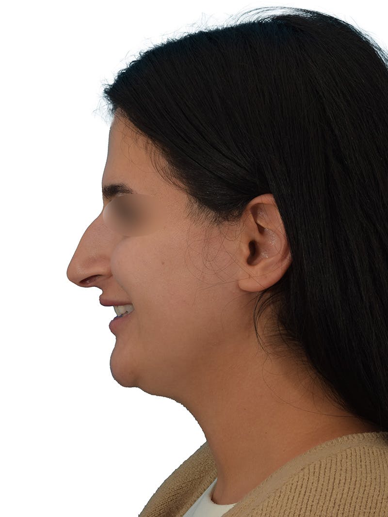 Rhinoplasty Before & After Gallery - Patient 229604 - Image 11