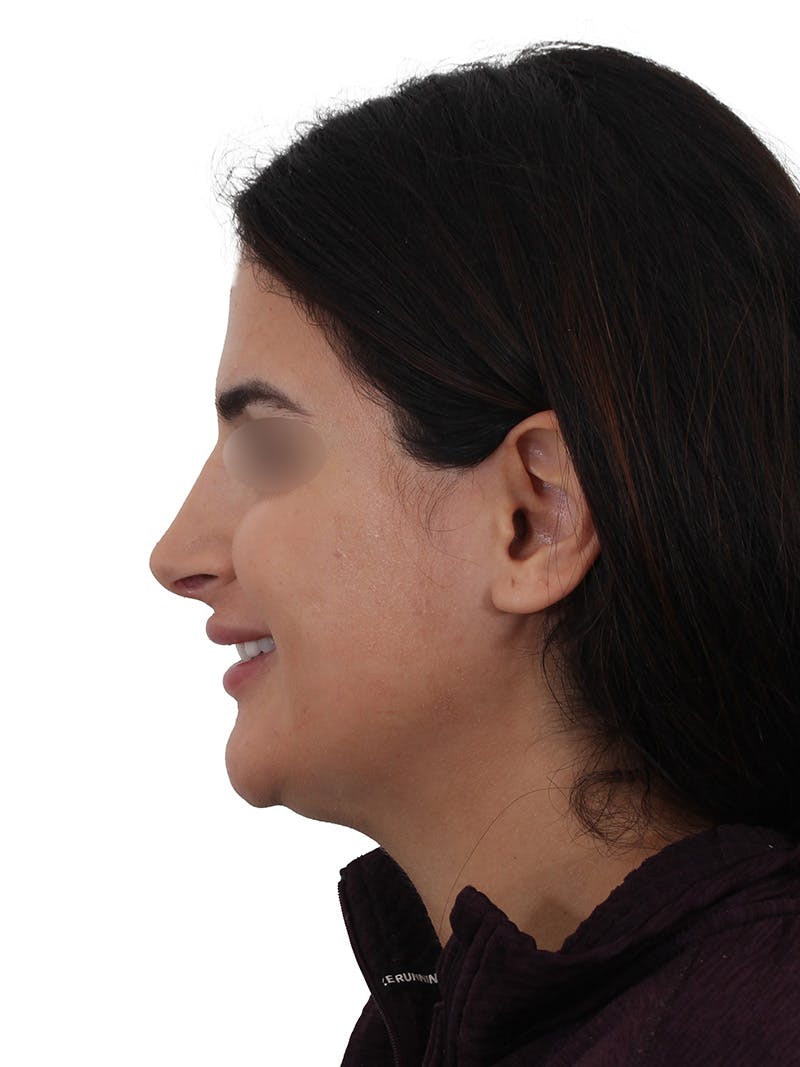 Rhinoplasty Before & After Gallery - Patient 229604 - Image 12