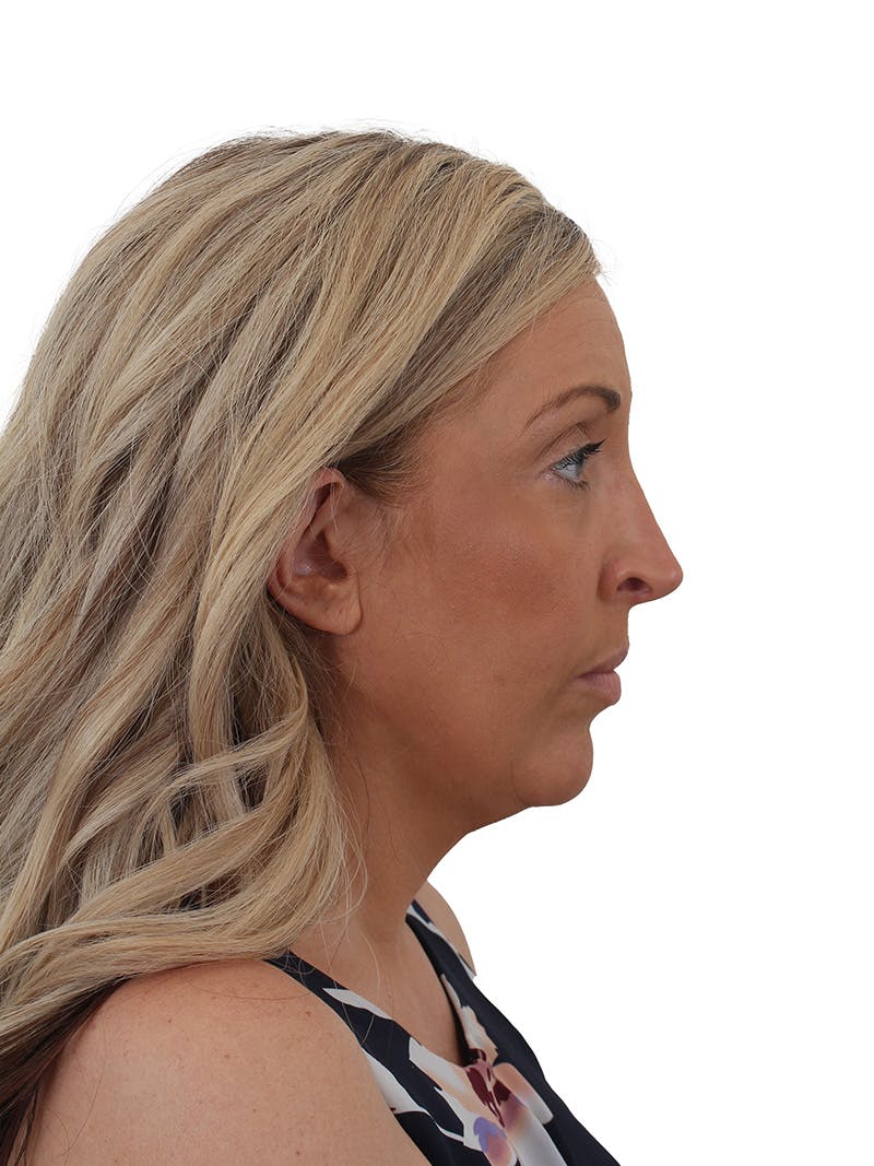 Rhinoplasty Before & After Gallery - Patient 292978 - Image 1