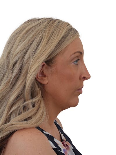 Rhinoplasty Before & After Gallery - Patient 292978 - Image 1