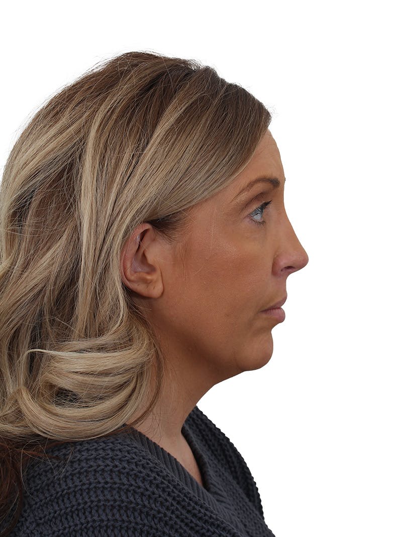 Rhinoplasty Before & After Gallery - Patient 292978 - Image 2