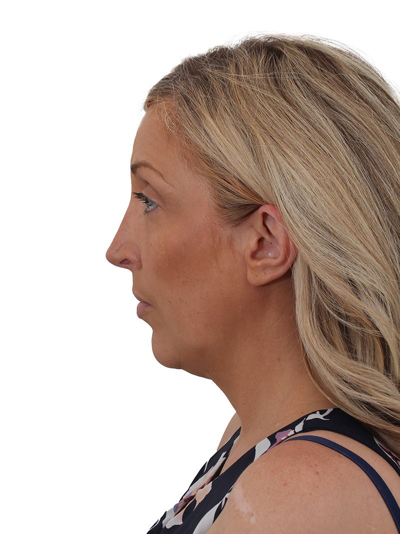 Rhinoplasty Before & After Gallery - Patient 292978 - Image 7