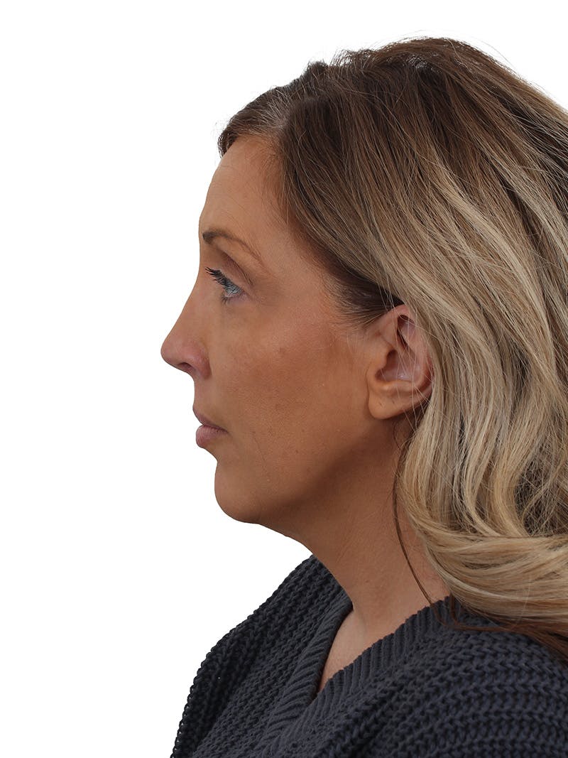 Rhinoplasty Before & After Gallery - Patient 292978 - Image 8