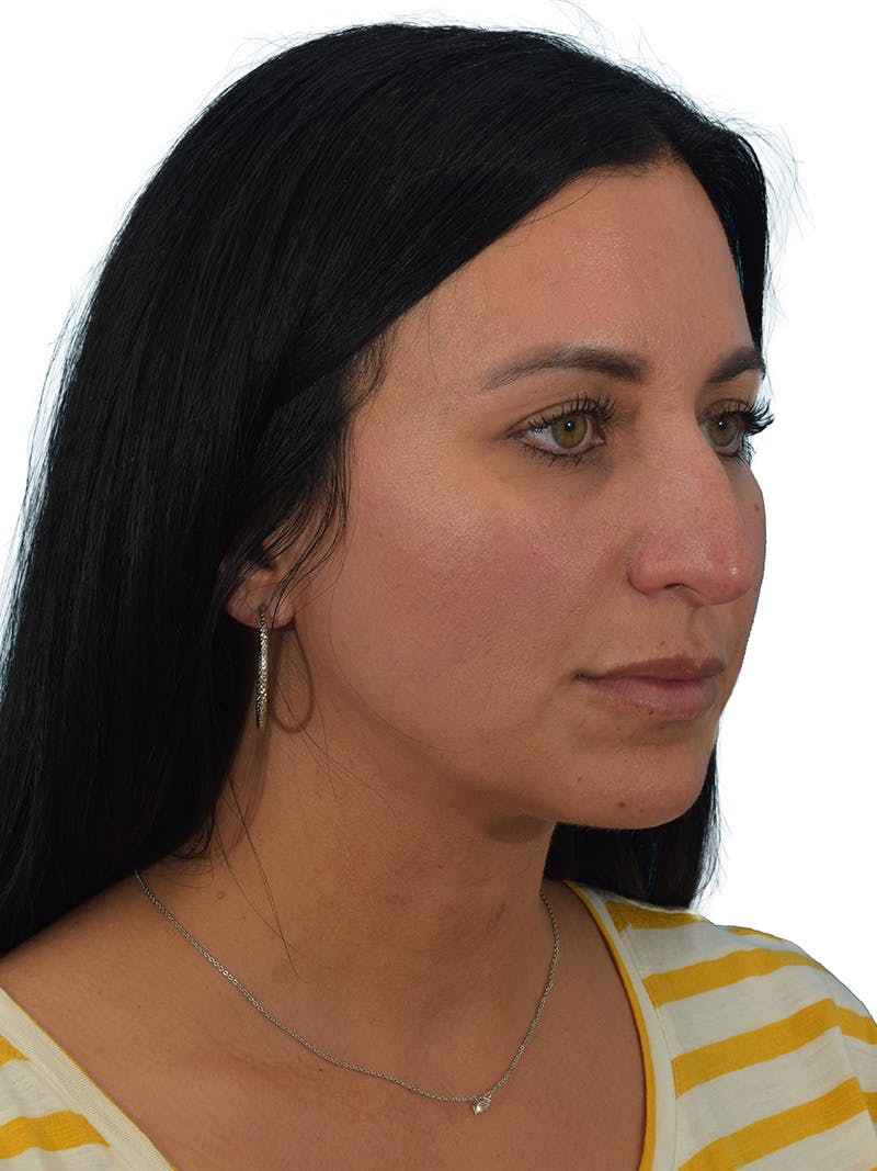 Rhinoplasty Before & After Gallery - Patient 394063 - Image 3