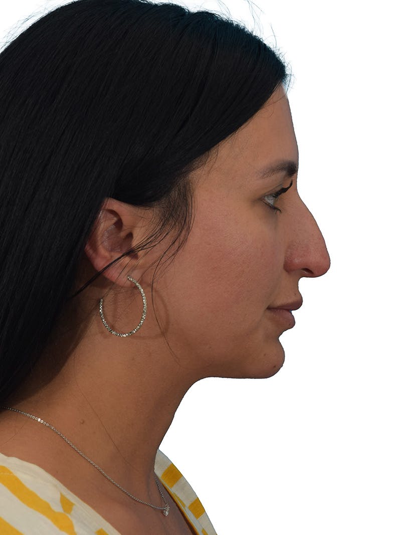 Rhinoplasty Before & After Gallery - Patient 394063 - Image 1