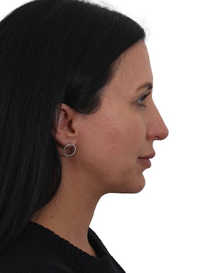 Rhinoplasty Before & After Gallery - Patient 394063 - Image 2