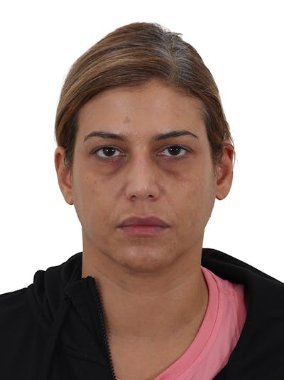 Laser Treatment Before & After Gallery - Patient 350695 - Image 1