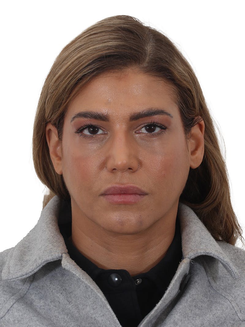Laser Treatment Before & After Gallery - Patient 350695 - Image 2