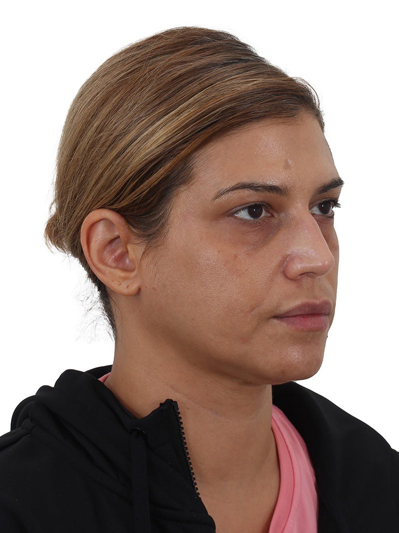 Blepharoplasty Before & After Gallery - Patient 366566 - Image 3