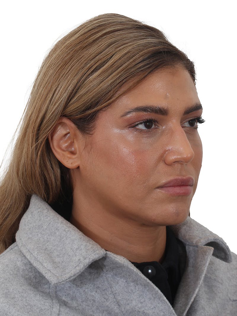 Skin Resurfacing Before & After Gallery - Patient 350695 - Image 4
