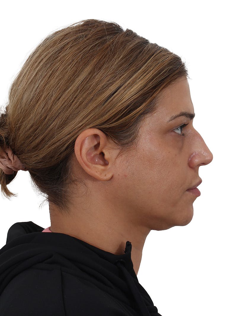 Laser Treatment Before & After Gallery - Patient 350695 - Image 5