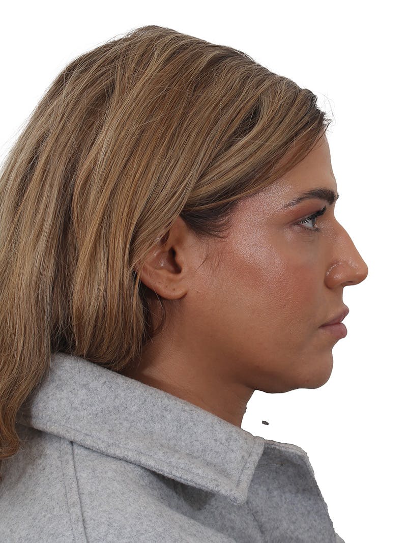 Laser Treatment Before & After Gallery - Patient 350695 - Image 6