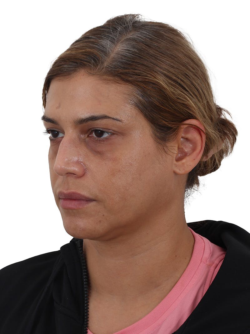 Laser Treatment Before & After Gallery - Patient 350695 - Image 7