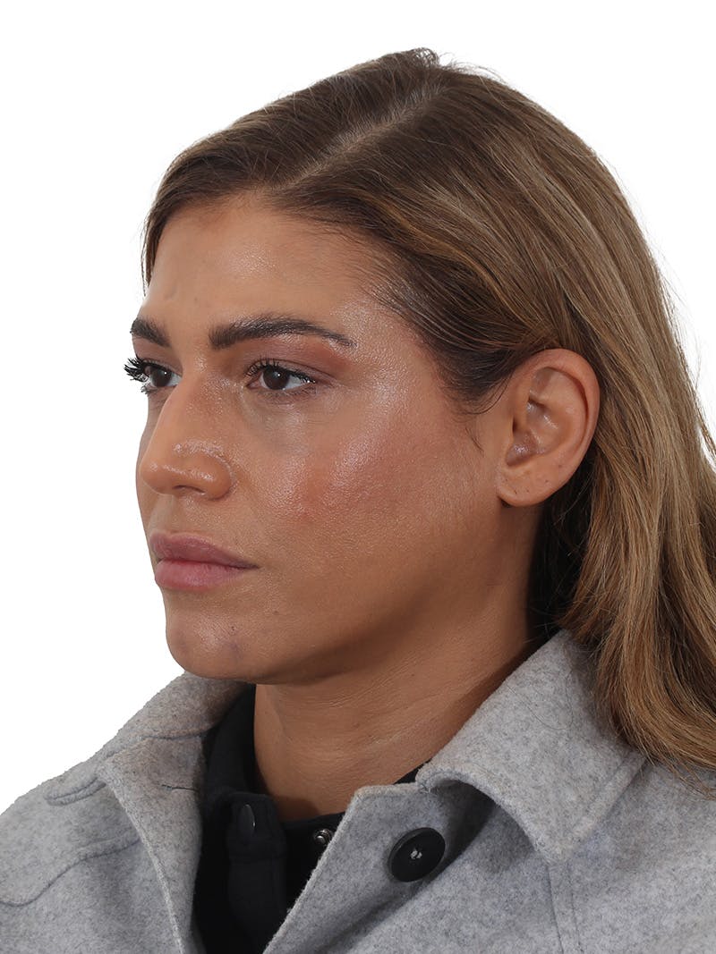 Laser Treatment Before & After Gallery - Patient 350695 - Image 8