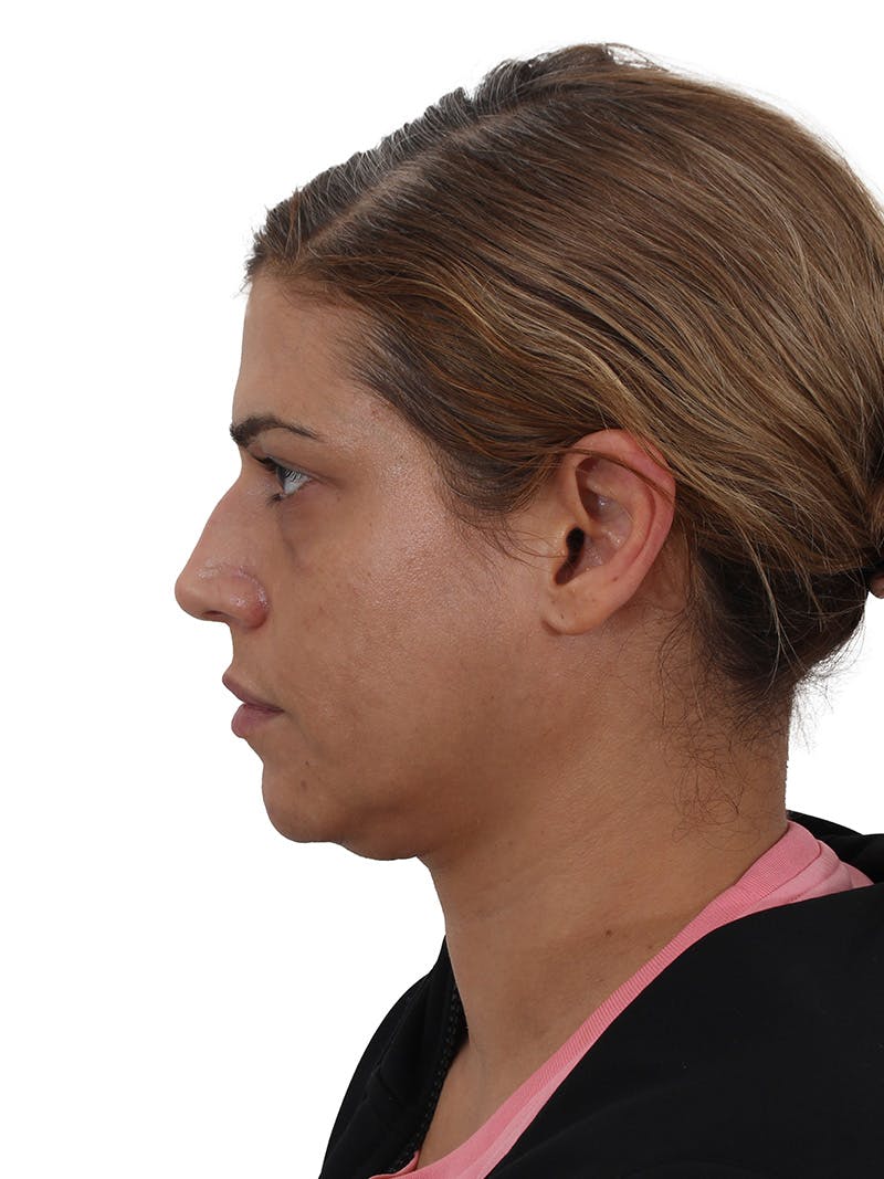 Blepharoplasty Before & After Gallery - Patient 366566 - Image 9