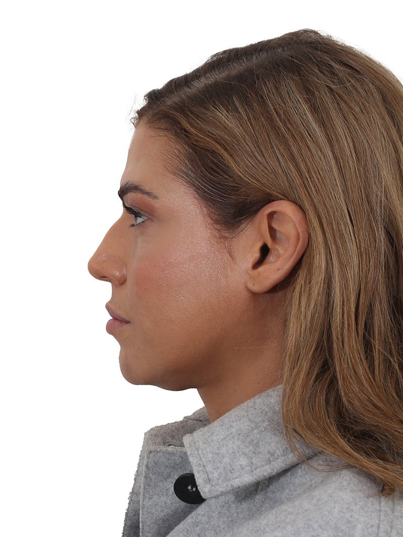 Laser Treatment Before & After Gallery - Patient 350695 - Image 10