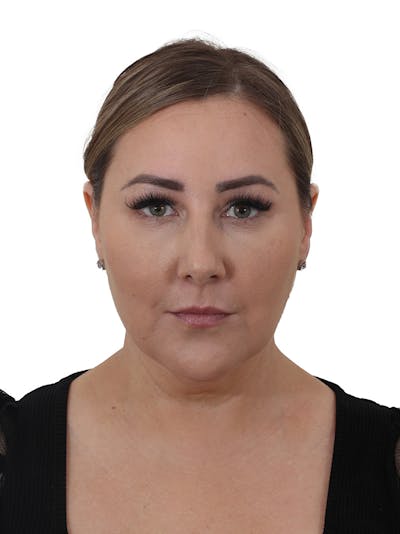 Facelift/Neck Lift Before & After Gallery - Patient 812296 - Image 1