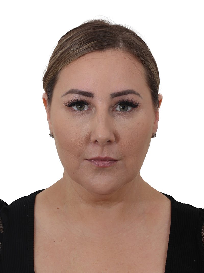 Facelift/Neck Lift Before & After Gallery - Patient 812296 - Image 3