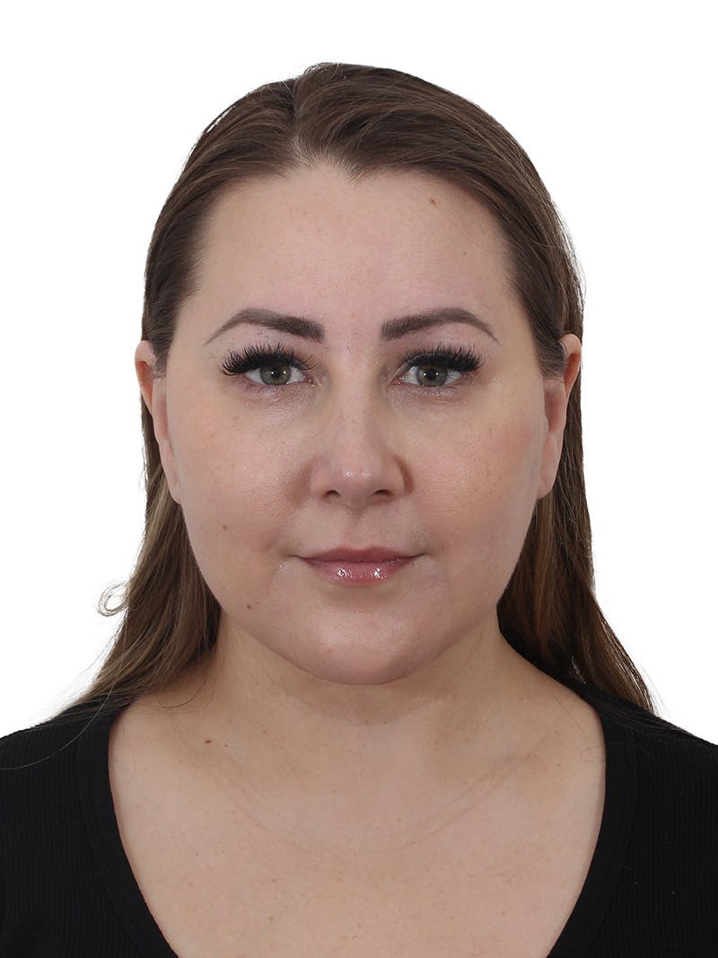 Facelift/Neck Lift Before & After Gallery - Patient 812296 - Image 4