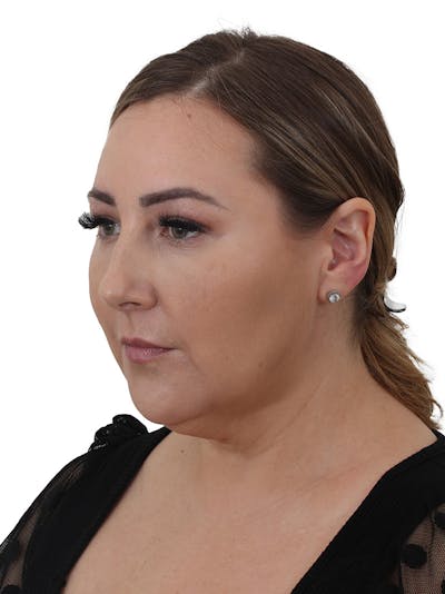 Facelift/Neck Lift Before & After Gallery - Patient 812296 - Image 1