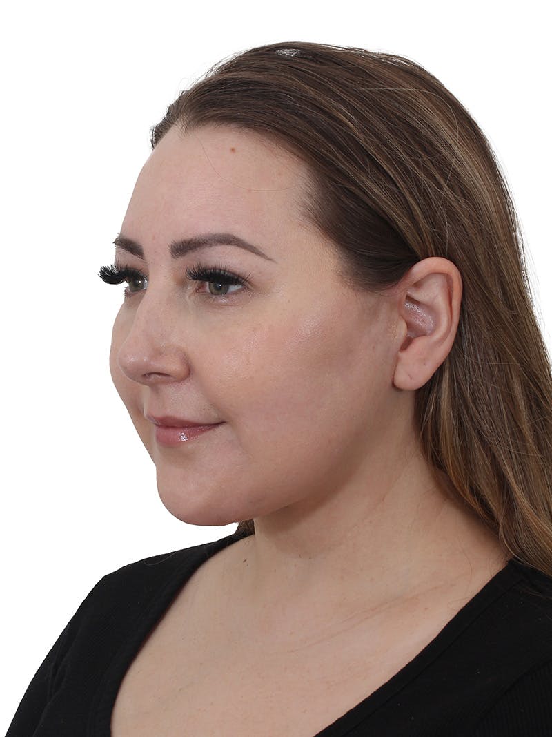 Facelift/Neck Lift Before & After Gallery - Patient 812296 - Image 2