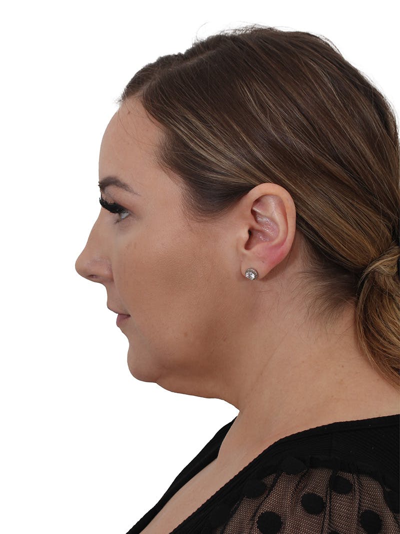 Facelift/Neck Lift Before & After Gallery - Patient 812296 - Image 5