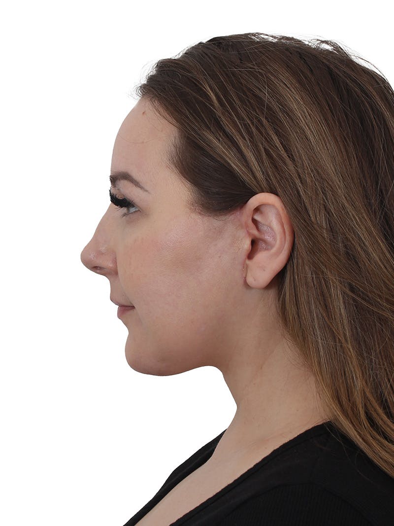 Facelift/Neck Lift Before & After Gallery - Patient 812296 - Image 6
