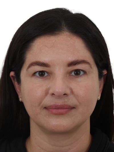 Blepharoplasty Before & After Gallery - Patient 261412 - Image 1