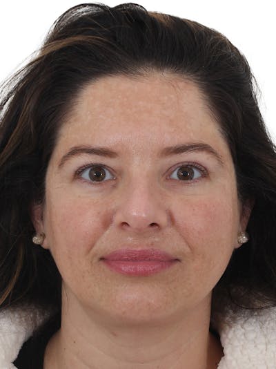 Blepharoplasty Before & After Gallery - Patient 261412 - Image 2