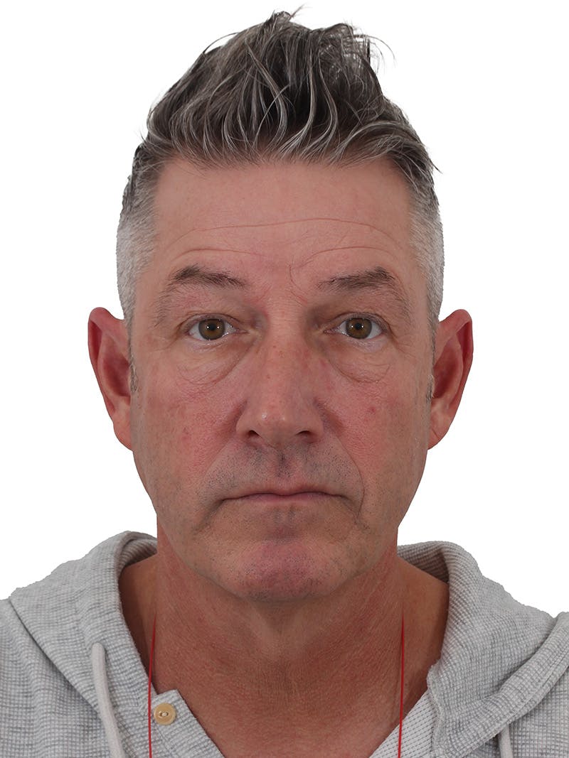 Laser Treatment Before & After Gallery - Patient 351892 - Image 1