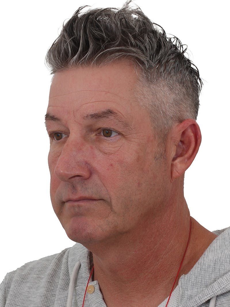 Laser Treatment Before & After Gallery - Patient 351892 - Image 3