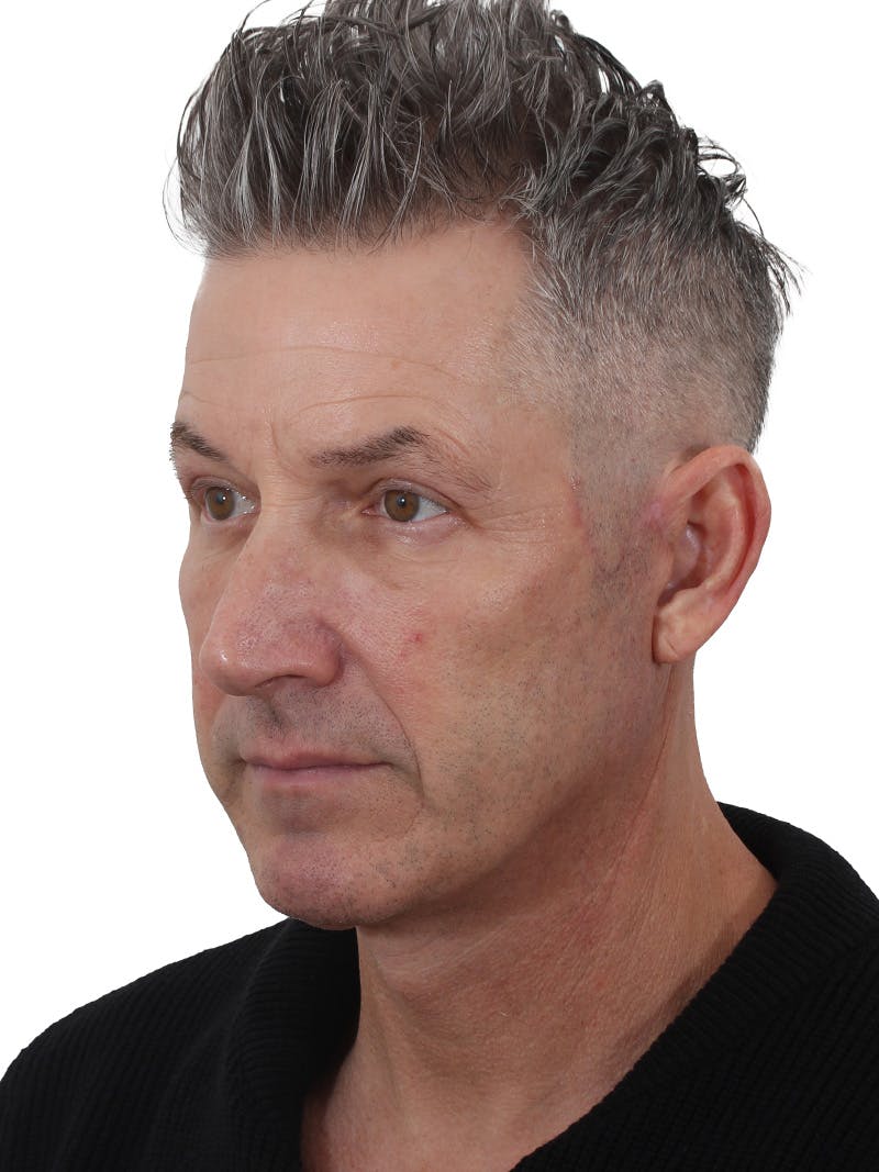 Laser Treatment Before & After Gallery - Patient 351892 - Image 4
