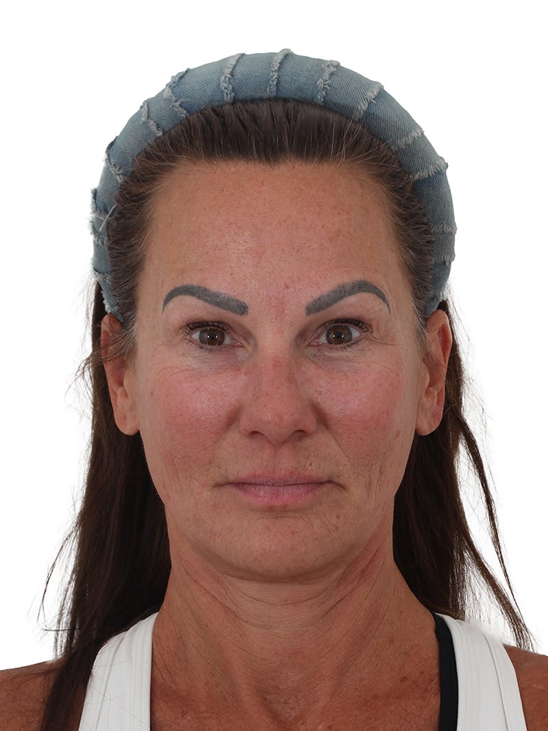 Facelift/Neck Lift Before & After Gallery - Patient 184197 - Image 3