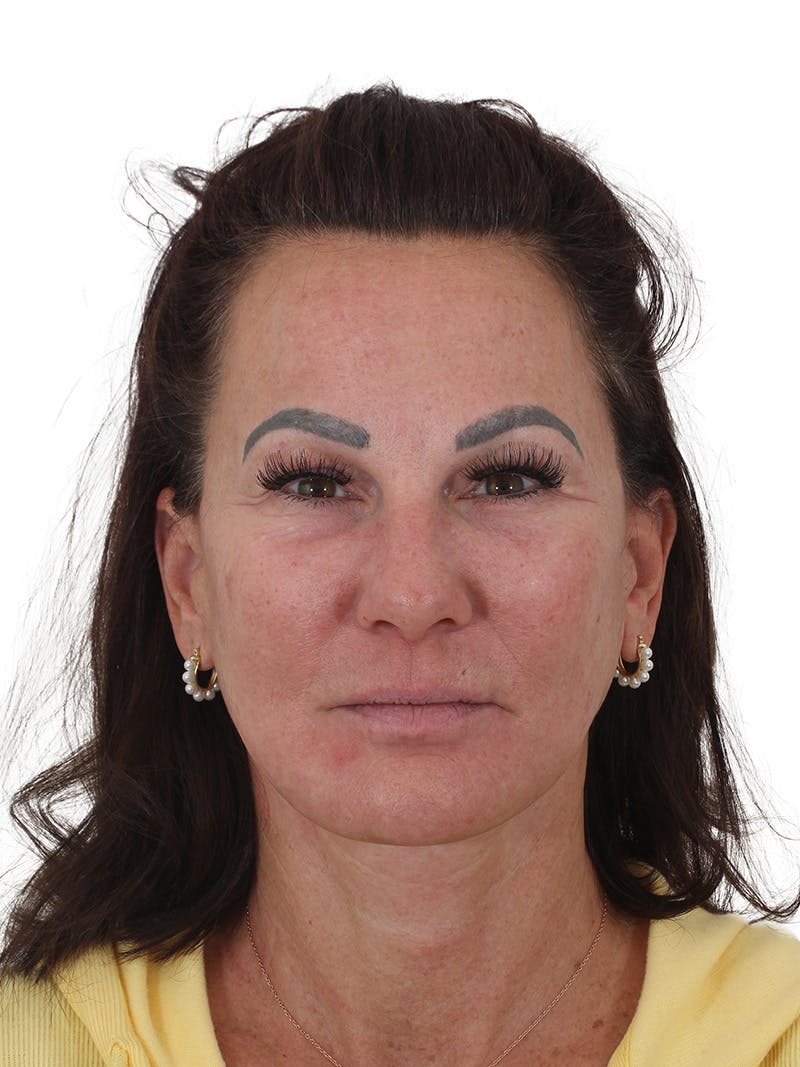 Facelift/Neck Lift Before & After Gallery - Patient 184197 - Image 4