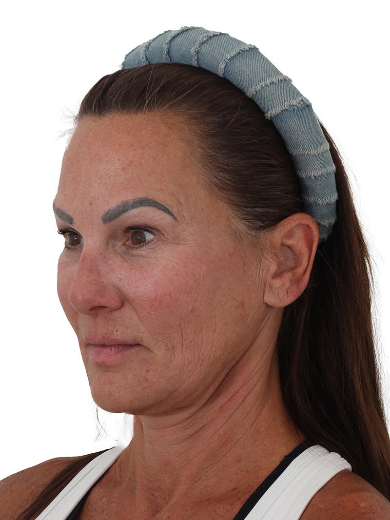 Facelift/Neck Lift Before & After Gallery - Patient 184197 - Image 1