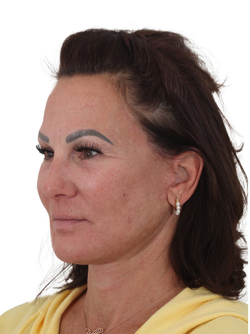 Facelift/Neck Lift Before & After Gallery - Patient 184197 - Image 2