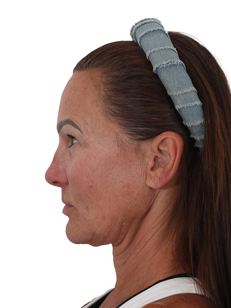 Facelift/Neck Lift Before & After Gallery - Patient 184197 - Image 5