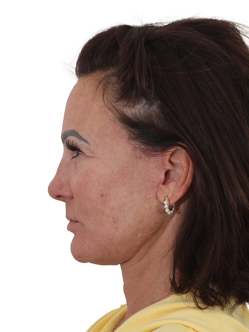 Facelift/Neck Lift Before & After Gallery - Patient 184197 - Image 6